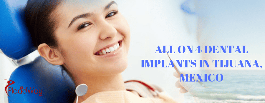 All On 4 Dental Implants in Tijuana, Mexico